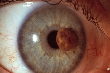 nádor oka (retinoblastóm)