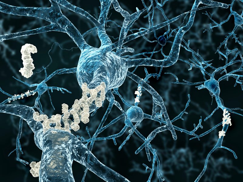 Ilustrácia amyloidových plakov na axónoch (výbežkoch) neurónov postihnutých Alzheimerovou chorobou. Zdroj: iStockphoto.com