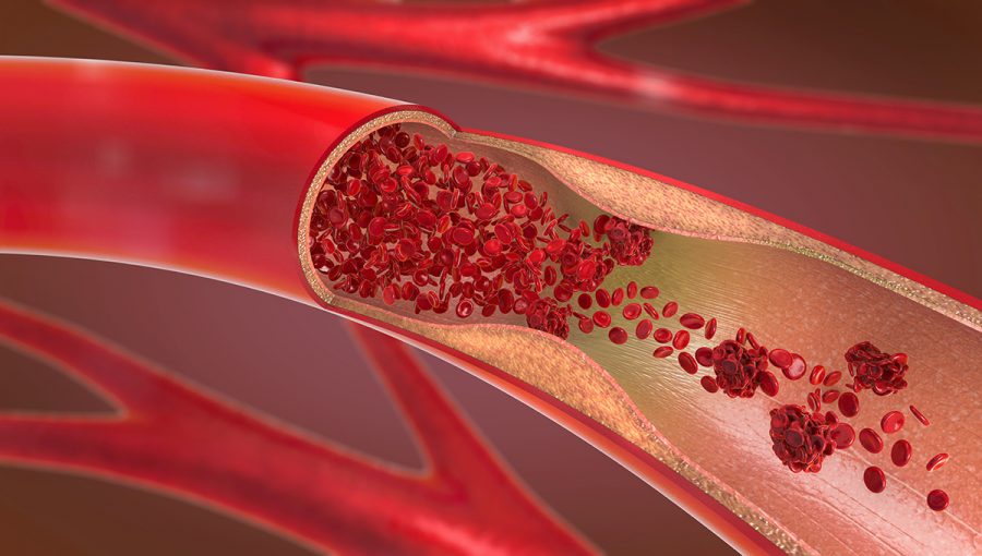 Červené krvinky zhlukujúce sa v tepne. Zdroj: iStockphoto.com