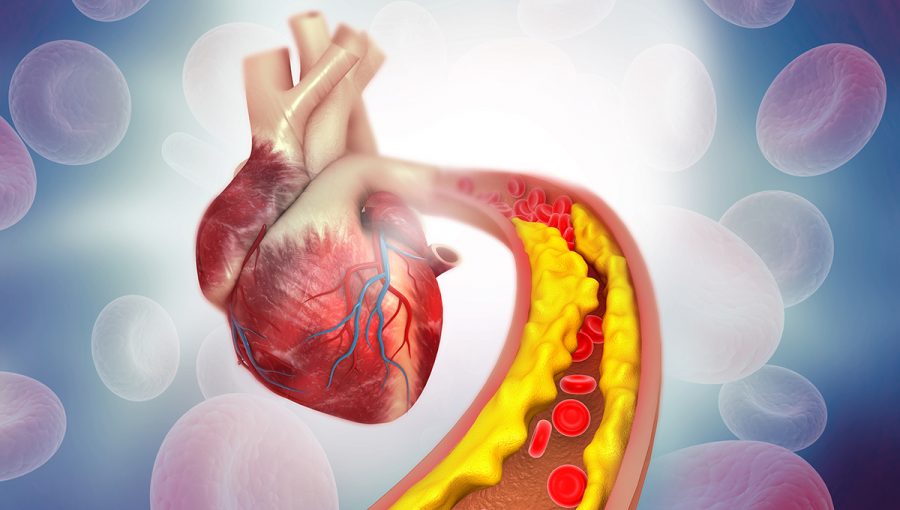 Povlak cholesterolu v tepne smerujúcej do srdca. Zdroj: iStockphoto.com