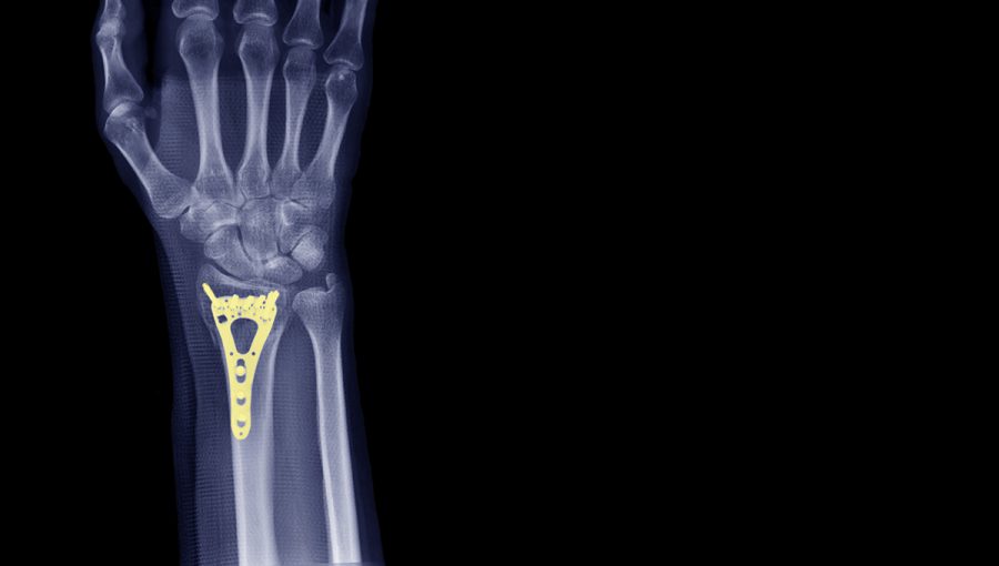 Röntgen ruky s ortopedickým implantátom. Zdroj: iStockphoto.com