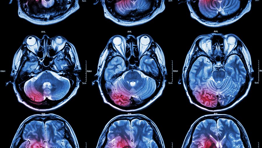 Snímky mozgu zhotovené pomocou magnetickej rezonancie. Zdroj: iStockphoto.com