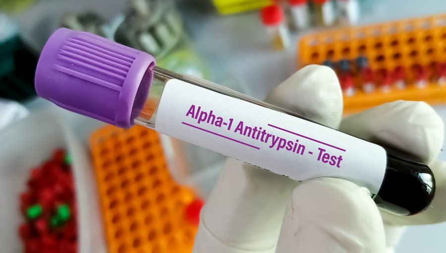 Vzorka krvi k testu na alfa-1 antitrypsín. Zdroj: iStockphoto.com