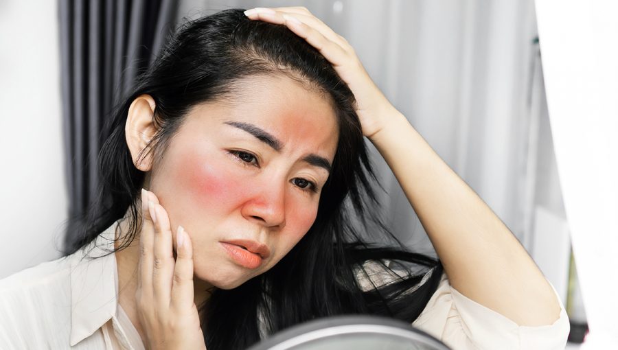 Žena má začervenanú kožu na tvári. Zdroj: iStockphoto.com