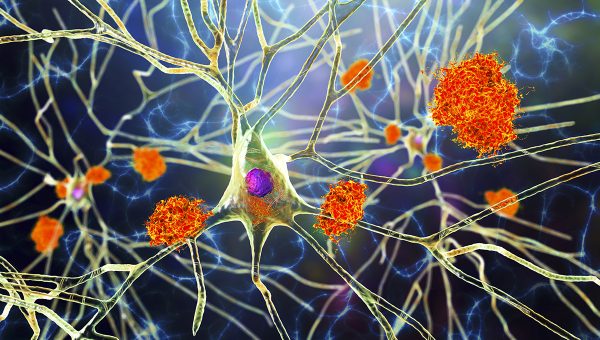 Hromadenie amyloidných plakov v mozgu. Zdroj: iStockphoto.com