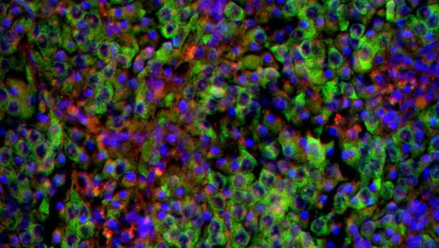 Bunky neuroblastómu (zelené) v nadobličke. Jadrá buniek sú sfarbené namodro.