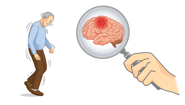 Parkinsonova choroba je chronické progresívne ochorenie nervovej sústavy. Vzniká v dôsledku degeneratívneho zániku nervových buniek v mozgu. Medzi hlavné príznaky radíme tras, tuhosť či nestabilitu tela. Ilustračný obrázok. Zdroj: iStockphoto.com