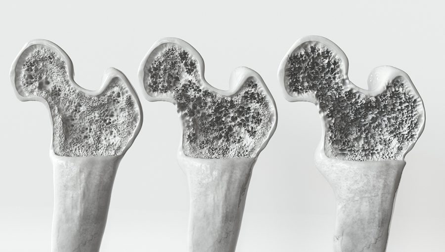 3 fázy osteoporózy. Zdroj: iStockphoto.com