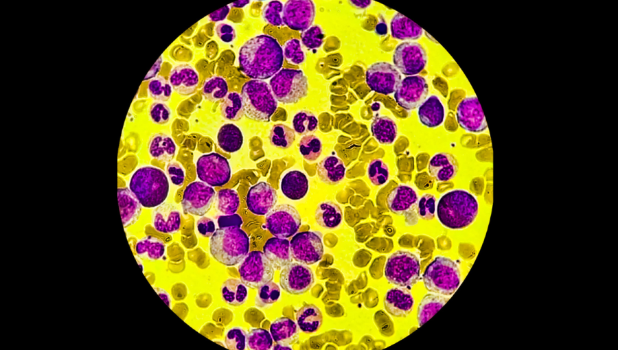 Mikrofotografia rakoviny krvi. Akútna myeloidná leukémia so zmenami analyzovaná mikroskopom.