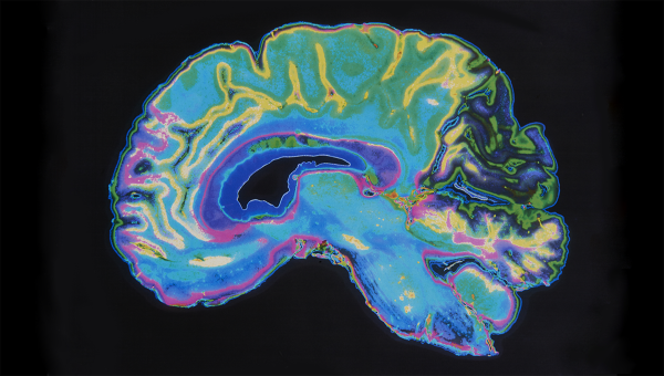 MRI snímka mozgu. Zdroj: iStockphoto.com