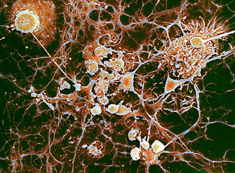 u ľudí s roztrúsenou sklerózou imunitné bunky (okrúhle, umelo sfarbené) napádajú bunky nervového systému nazývané oligodendrocyty (rozvetvujúce sa štruktúry). Poďakovanie: Profesor John Zajicek/Science Source Library