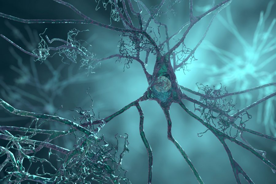 Neuróny s amyloidnými plakmi. Zdroj: iSTockphoto.com