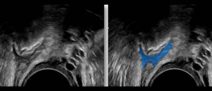 Ultrazvukový záznam s farebne vyznačenou endometriózou