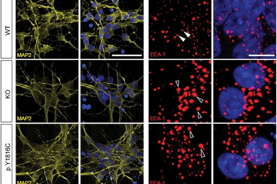 Zväčšené endozómy (červenou) u neurónov s mutáciou a u neurónov bez funkčného génu SORL1. Zväčšenie endozómov je jedným z prejavov, ktoré môžu súvisieť s poruchou transportných procesov vedúcich k Alzheimerovej chorobe.