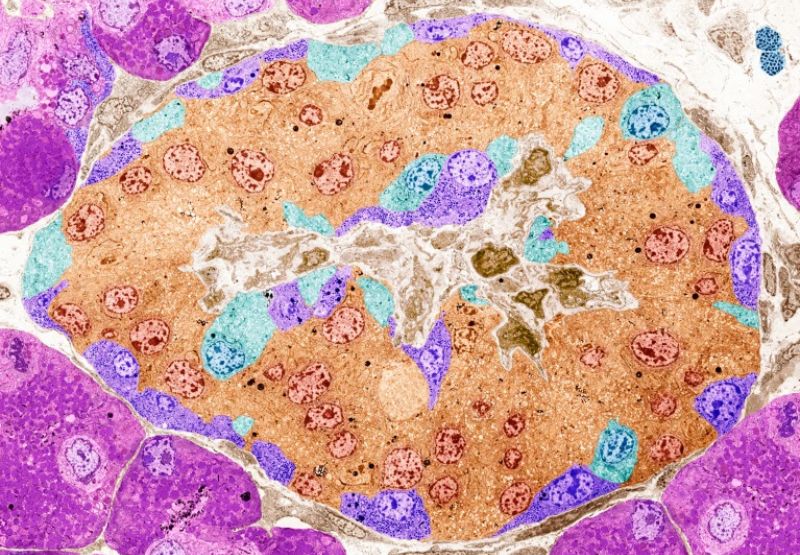 Pankreatické ostrovčeky (umelo sfarbené) u ľudí s cukrovkou 1. typu nevylučujú dostatočné množstvo inzulínu.