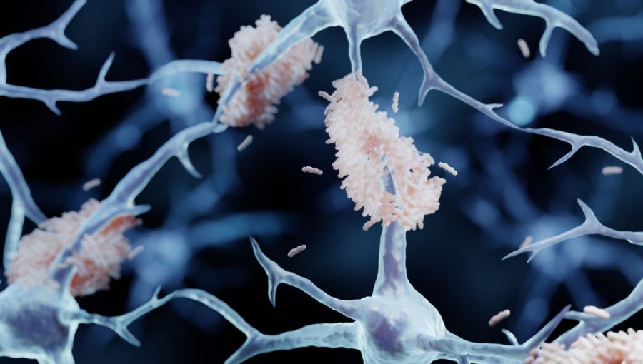 Amyloidné plaky pri Alzheimerovej chorobe. Zdroj: iStock/Artur Plawgo