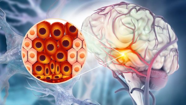 Dáta ukazujú, že na Slovensku dochádza k takmer desiatim tisíckam mozgových príhod, čo predstavuje približne 129,3 mŕtvic na 100 000 obyvateľov. Najčastejšie sa vyskytuje u ľudí vo veku 60 – 69 rokov. Rizikovým faktorom je najmä vysoký krvný tlak. Zdroj: iStock/Mohammed Haneefa Nizamudeen