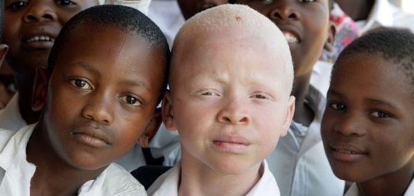 Albinizmus patrí medzi vrodené tzv. autozomálne recesívne choroby