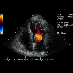 Znázornenie prúdenia krvi v jednotlivých oddieloch srdca pomocou echokardiografie s využitím Dopplerovho javu. Rýchlosť prúdenia krvi znázorňuje farebná škála.