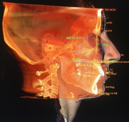 Fúzia CBCT a 3D fotky pacientky