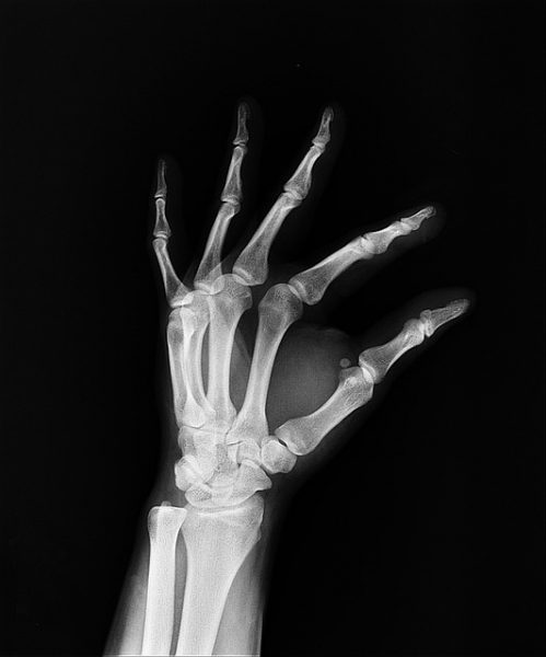 Ilustračné foto: röntgen; Pixabay.com /com329329/