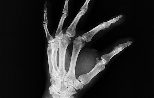 Ilustračné foto: röntgen; Pixabay.com /com329329/