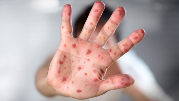 Ilustračné foto: Detská dlaň posiata osýpkami (červené pupence). Zdroj: iStockphoto.com
