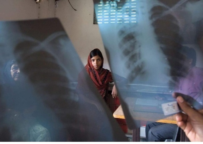 Zdroj obrázkov – WHO, Global tuberculosis report 2017