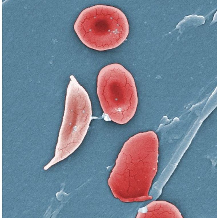 Zdravé červené krvinky vedľa krvinky postihnutej kosáčikovitou anémiou. Zdroj: Wikimedia.com