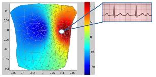 Počítačom simulované zobrazenie elektrického poľa srdca na základe štandardného EKG vyšetrenia, kde sú oblasti negatívnych a pozitívnych potenciálov zobrazené farebnou škálou. Takto je možné hodnotiť chorobné zmeny elektrickej činnosti srdca aj na miestach, ktoré sa nesnímajú pri použití elektród klasického EKG. 