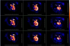 Pohľad na činnosť srdca pomocou magnetickej rezonancie. Obrázky zachytávajú časovú sekvenciu činnosti srdca a tvoria podklad pre kinematografické zobrazenie – animované zobrazenie pulzujúceho srdca v reálnom čase.