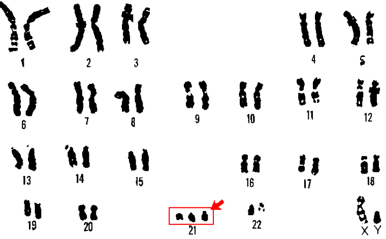 Chromozómy. Červený obdĺžnik poukazuje na genetickú poruchu na 21. chromozóme, ktorá spôsobuje Downov syndróm. Foto: U.S. Department of Energy Human Genome Program Zdroj: Wikipedia.com