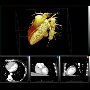 V hornej časti obrázka je trojrozmerné zobrazenie srdca a priľahlého cievneho systému. V spodnej časti sú rezy hrudníka získané počítačovou tomografiou, z ktorých sa konštruuje trojrozmerný obraz.