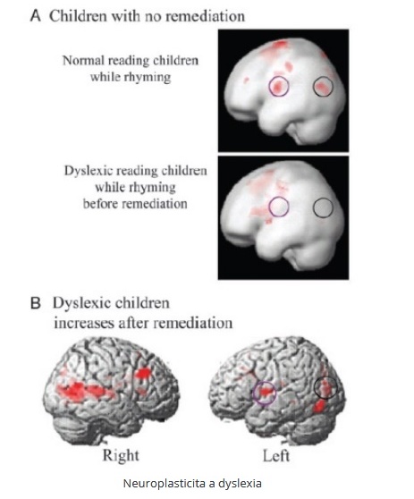 Neuroplasticita a dyslexia