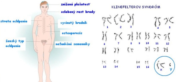 Klinefelterov syndróm / zdroj: http://www.1sg.sk/www/data/01/projekty/2008_2009/jets/genetika_v_laboratoriu/2strana.html 
