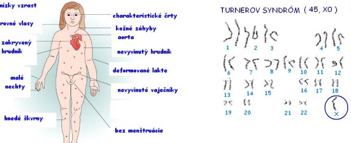 Turnerov syndróm / zdroj: http://www.1sg.sk/www/data/01/projekty/2008_2009/jets/genetika_v_laboratoriu/2strana.html 