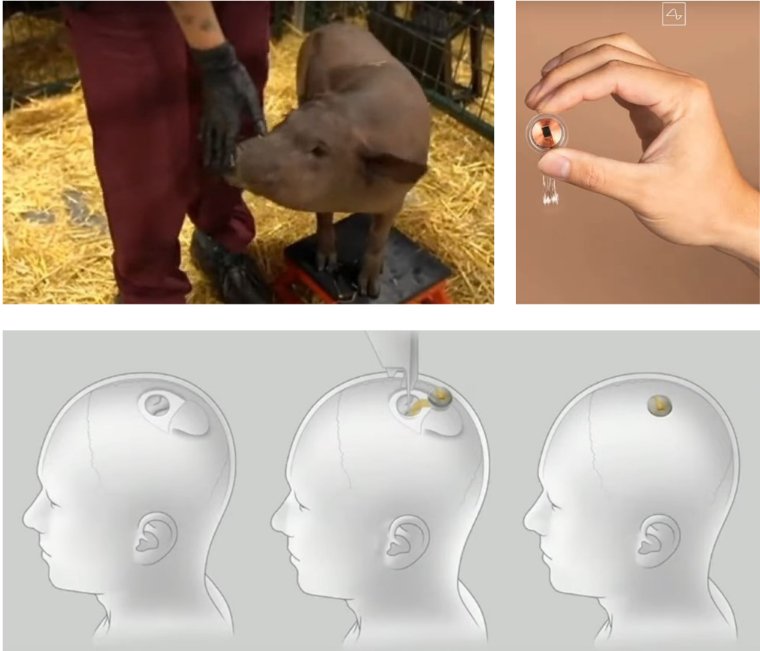 Hore vľavo: ošípaná Gertruda, ktorá má 2 mesiace implantovaný v mozgu čip. Vpravo: čip Neuralinku. Dole: nákres implantácie čipu do ľudského mozgu. Zdroj: YouTube